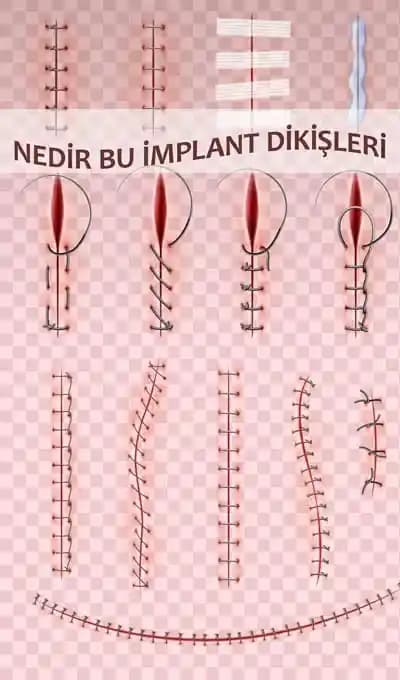 Ameliyat Sonrası Dikişleri Gizlemek İçin İç Mekanda Kullanılabilecek Şapka Modelleri ve Seçim Kriterleri