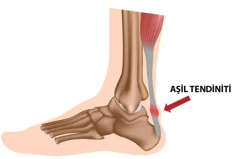 Abiye Ayakkabılarda Aşil Tendonuna Sürtme Sorununu Önleme Yöntemleri ve İpuçları